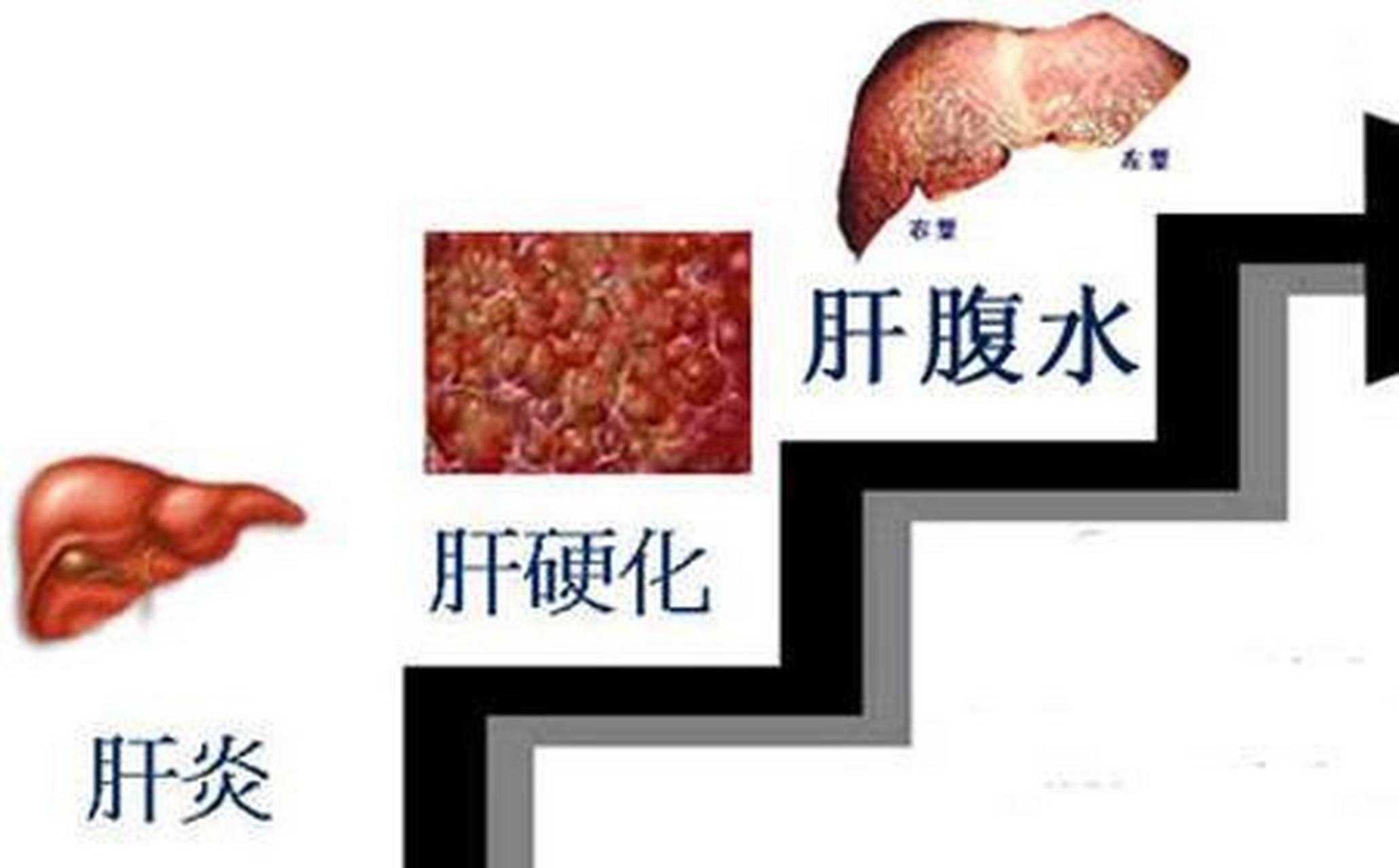 【酒精性肝硬化的症状 肝硬化在失代偿期和代偿期的症状是不一样的