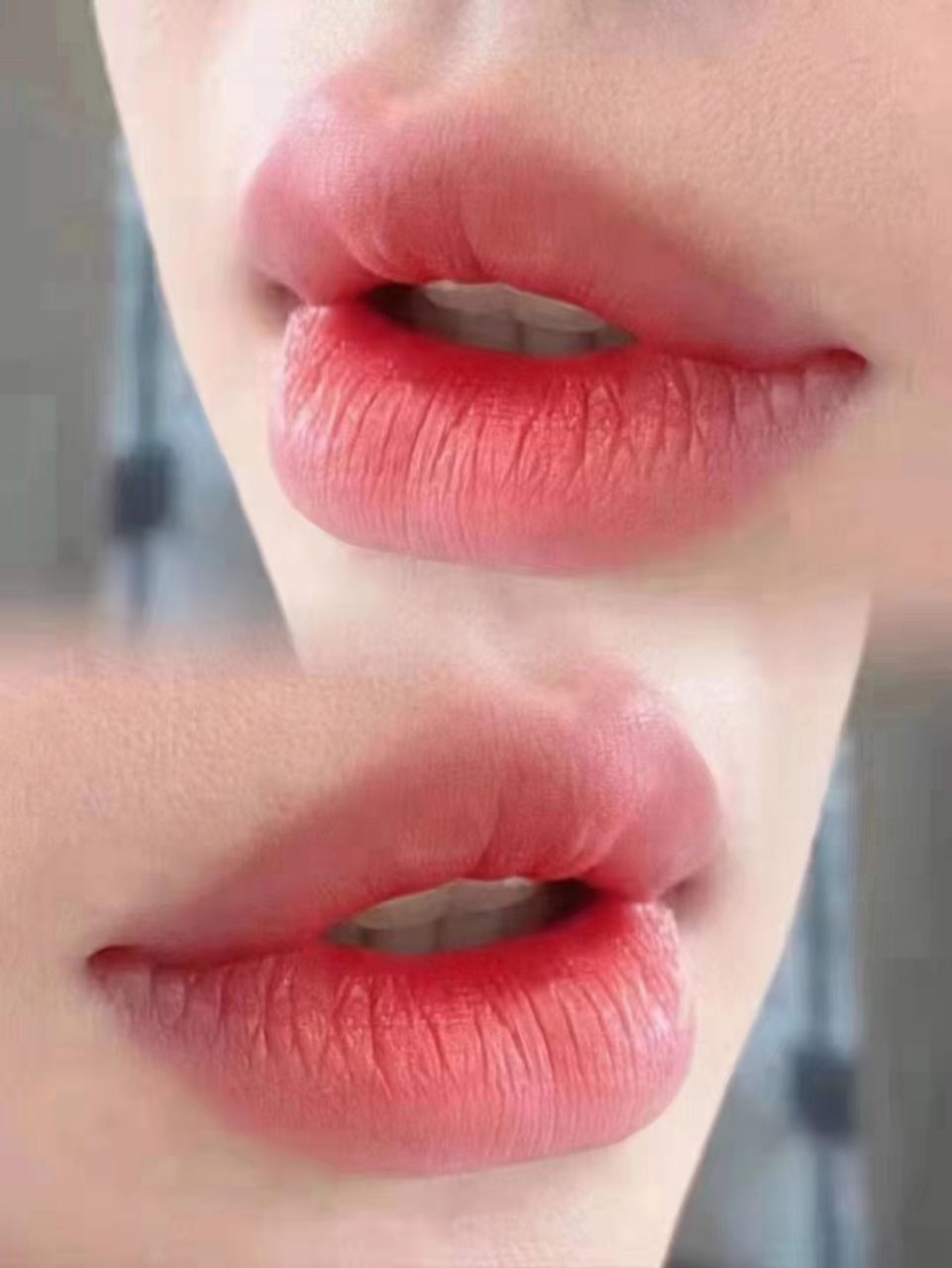 玻尿酸丰唇# #玻尿酸填充# #玻尿酸丰唇珠# #邢台伊美整形# #邢台