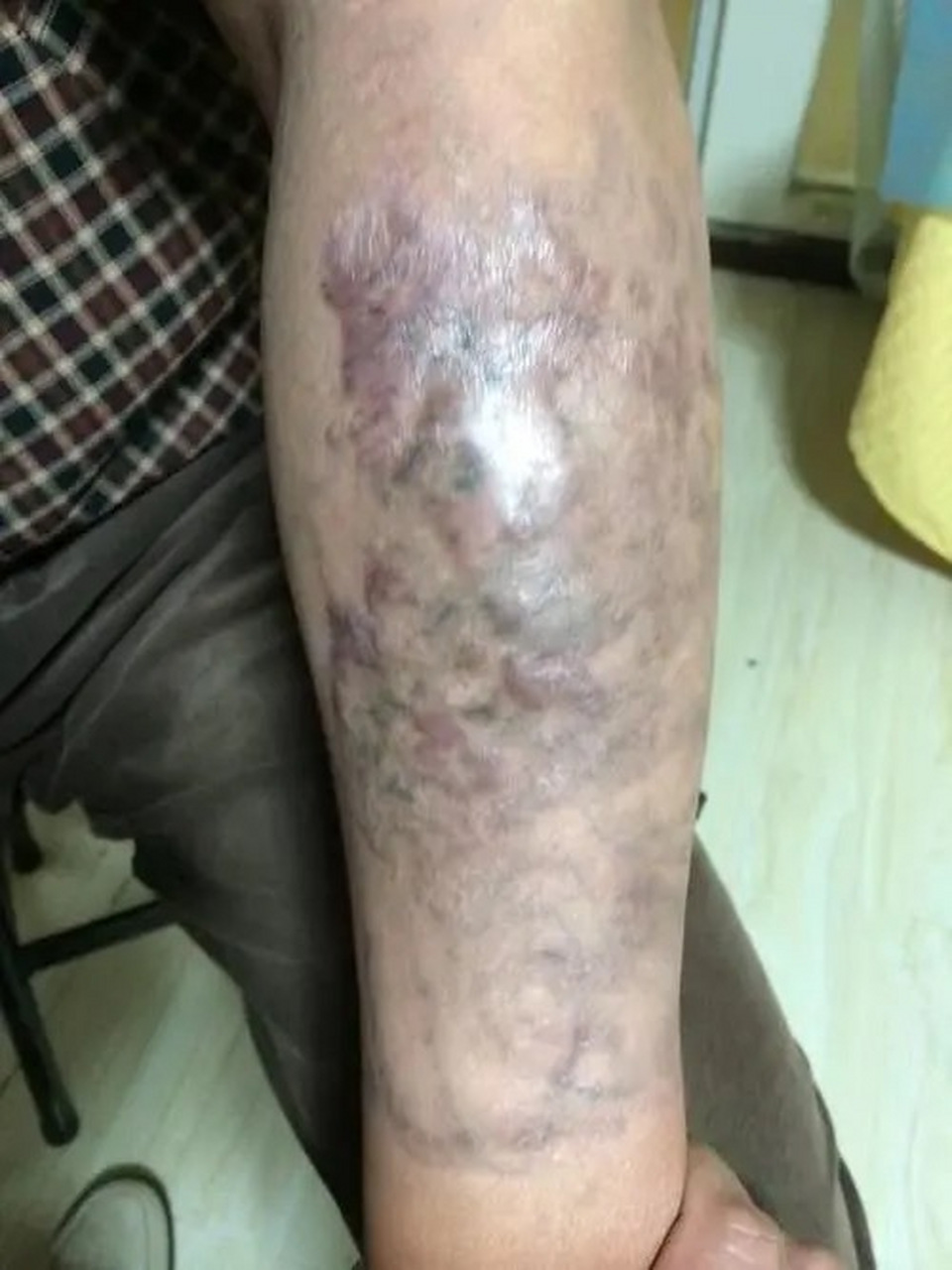 皮秒可以洗纹身吗?  皮秒激光是一种激光技术,可以用于去除纹身.