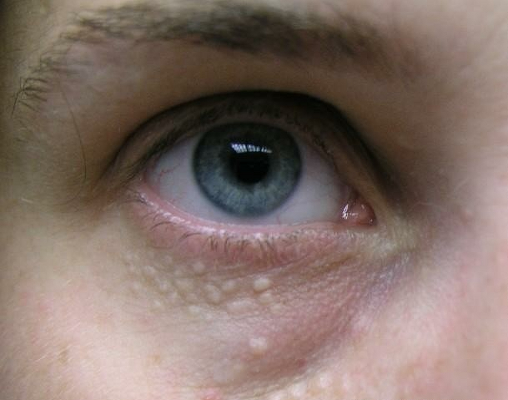 眼睛周围突然出现这种密密麻麻的小点是什么呢?