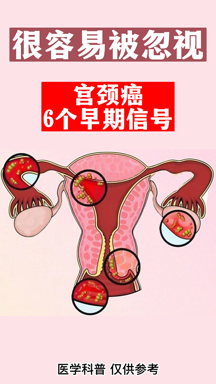 希望大家可以注意到,避免悲剧的发生#宫颈癌# #癌症# #健康# #健康早