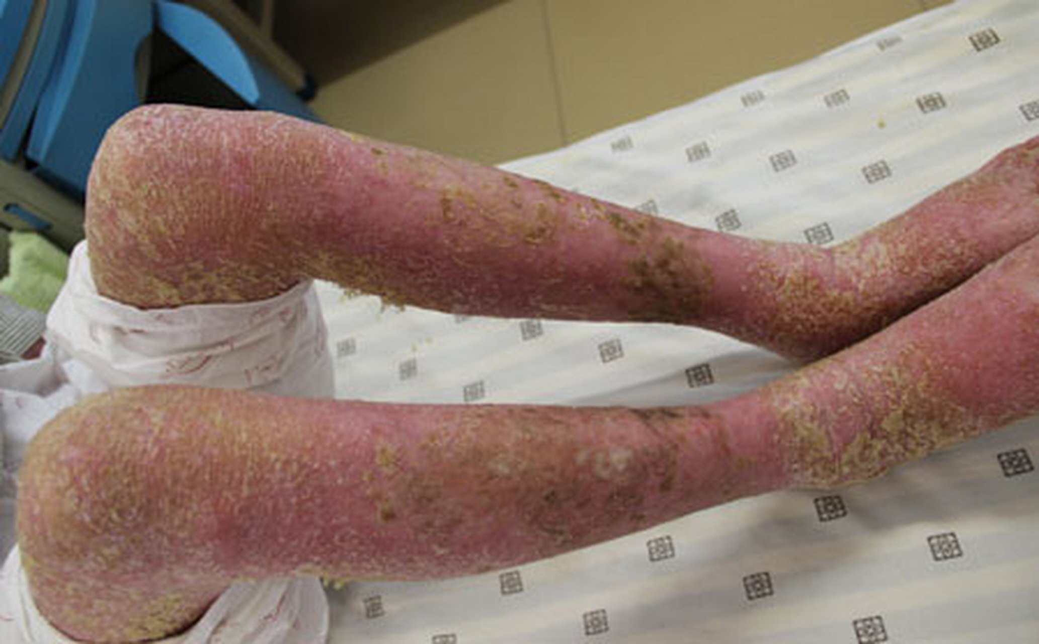 9月好消息来了,对称型的牛皮癣很好治!