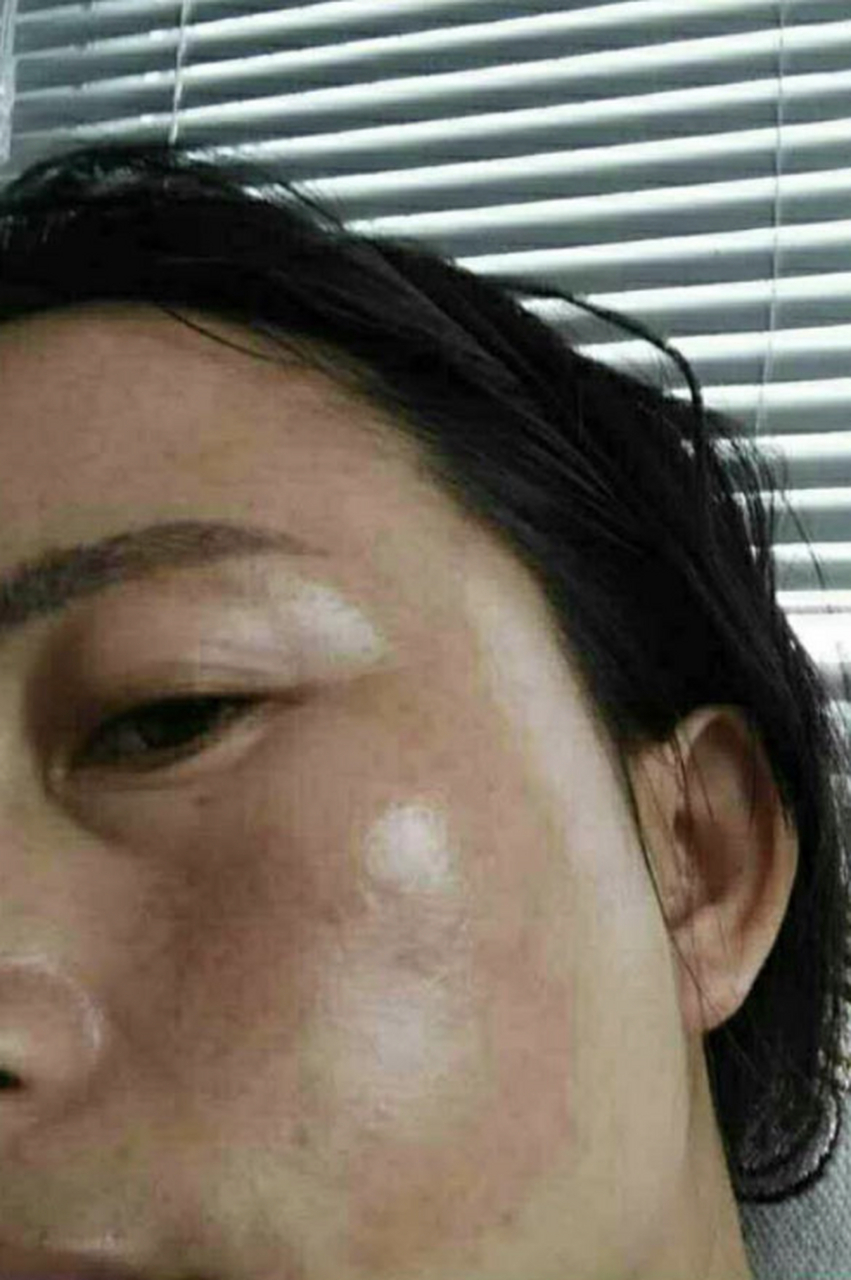 激光祛斑# 黄褐斑有办法去掉吗 黄褐斑是一种常见的色素沉着性皮肤病