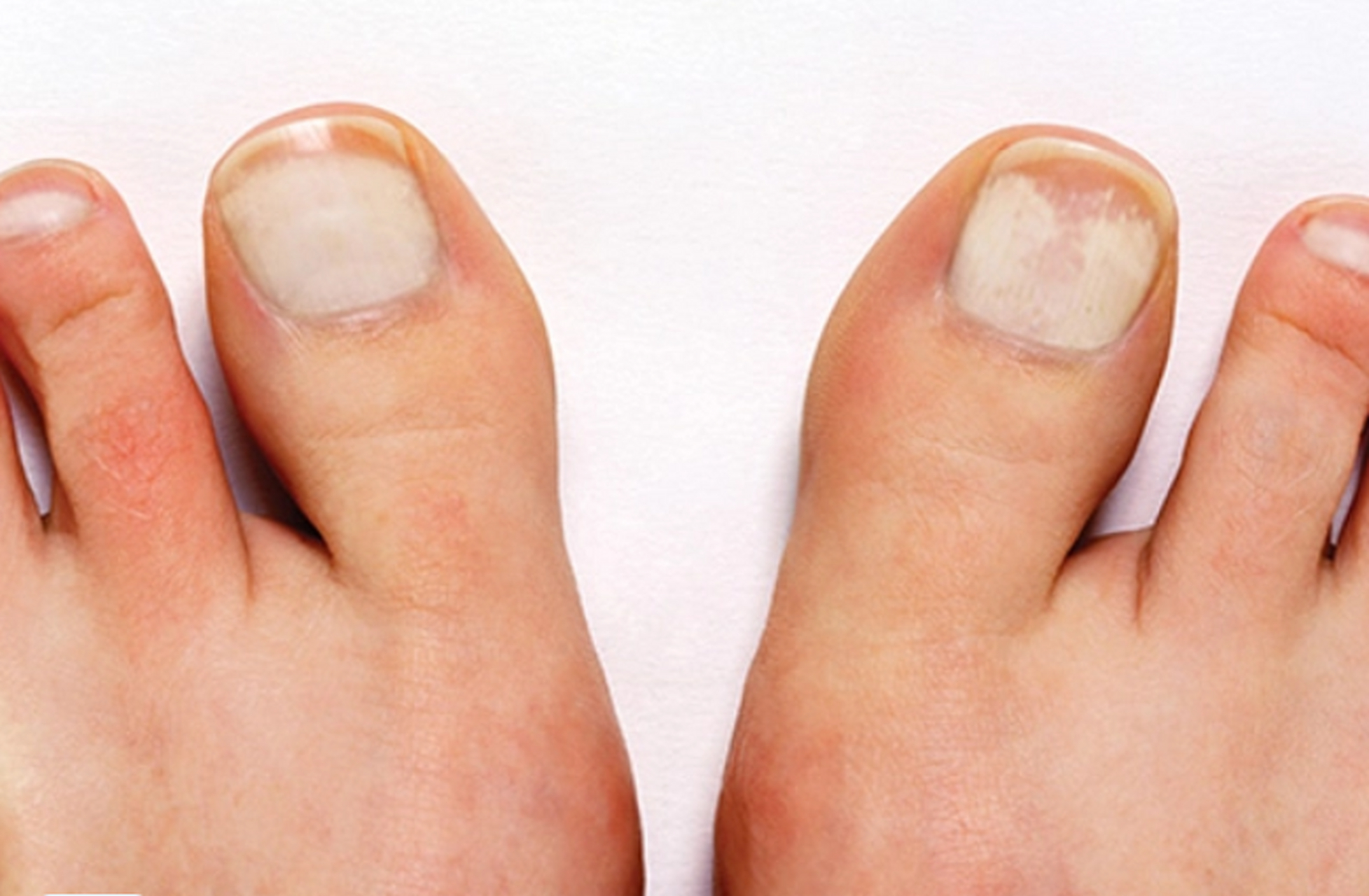 脚趾甲的十种颜色代表不同的健康状况!