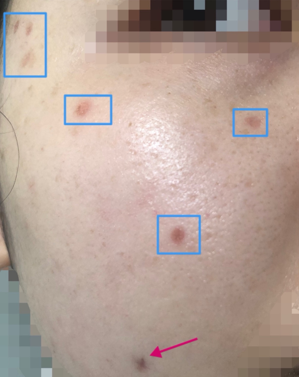 激光点痣的原理: 激光点痣是利用激光可以瞬间爆发巨大能量的特 