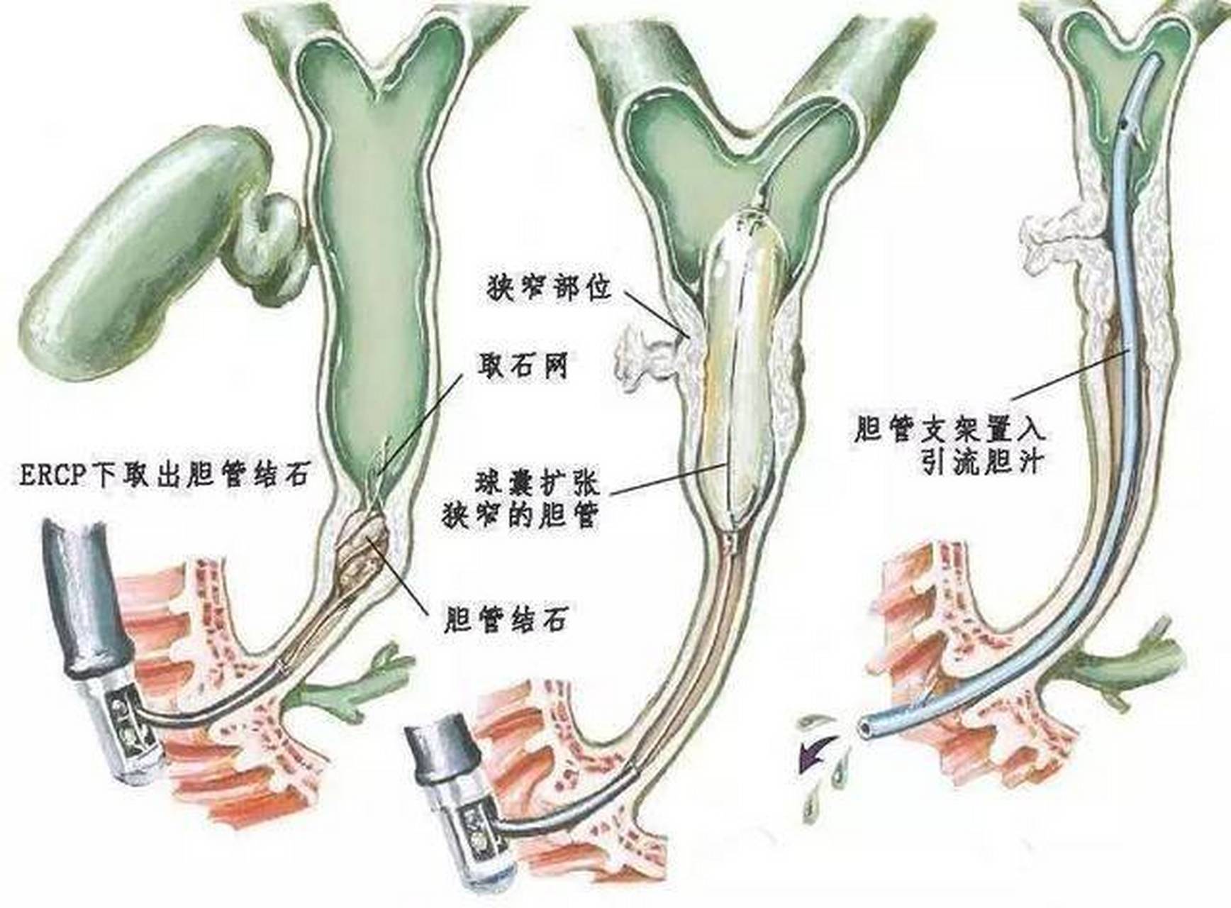 胆管支架主要适用于相关的疾病引起的胆道狭窄,从而放置支架,以便能