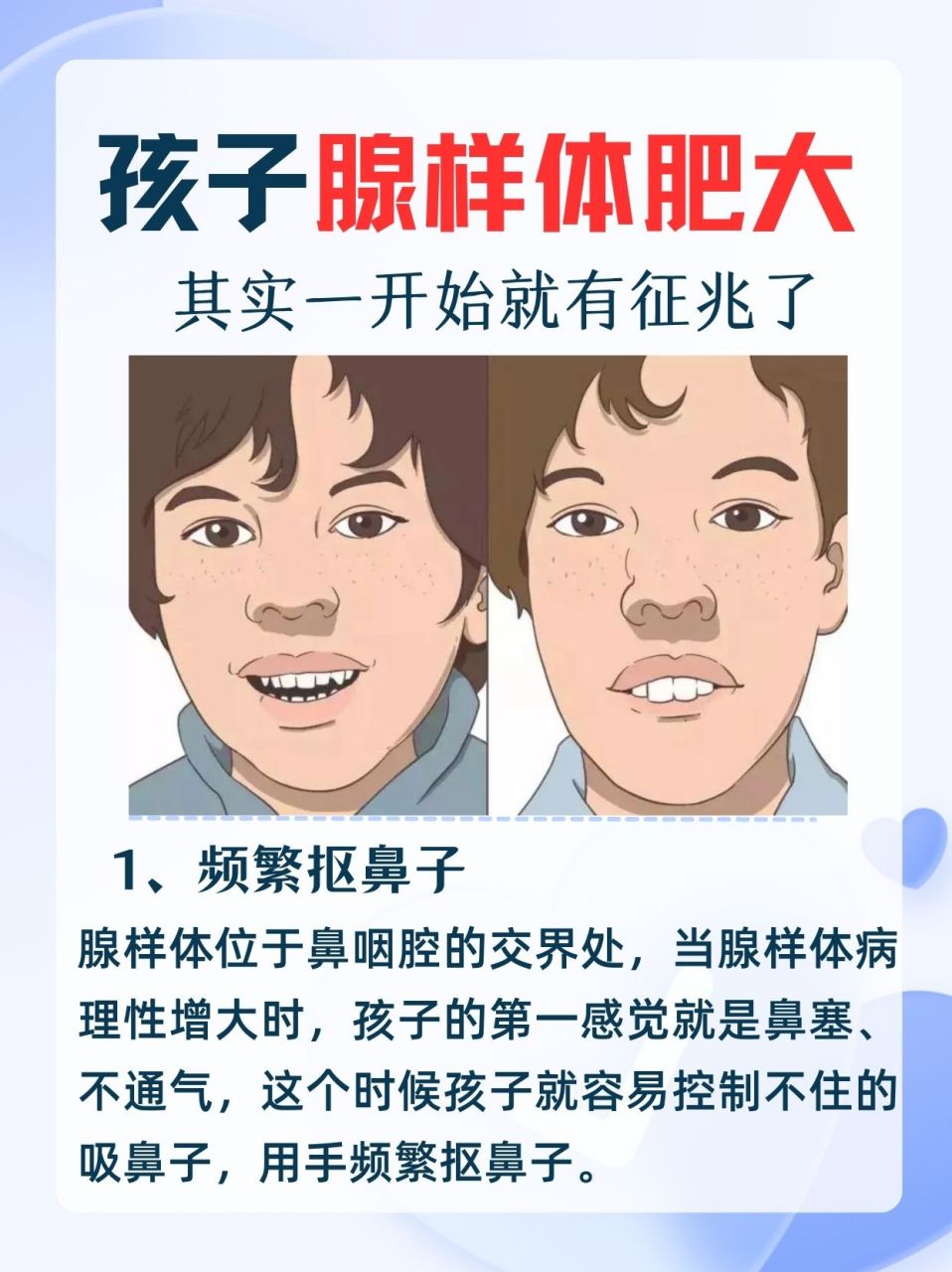 腺样体肥大的早期表现,很多家长都忽略了  1,频繁抠鼻子,捏鼻子,揉