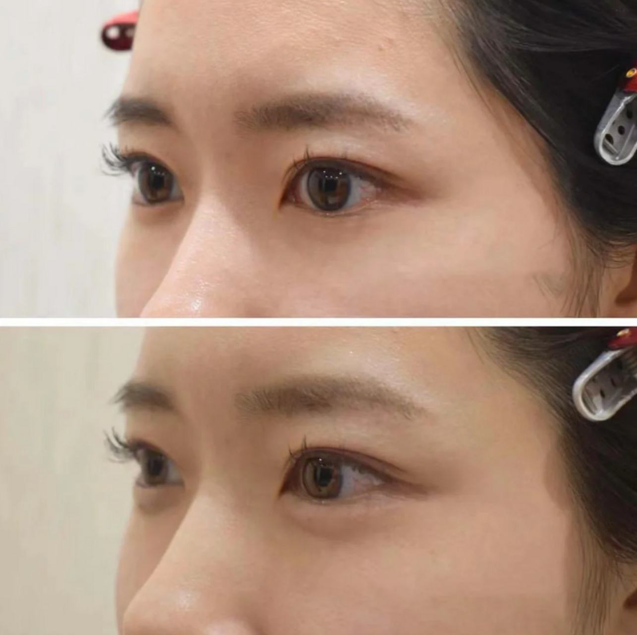 i健康笔记创作赛# 那些年做过的医美项目|91注射卧蚕 医美人爱做的