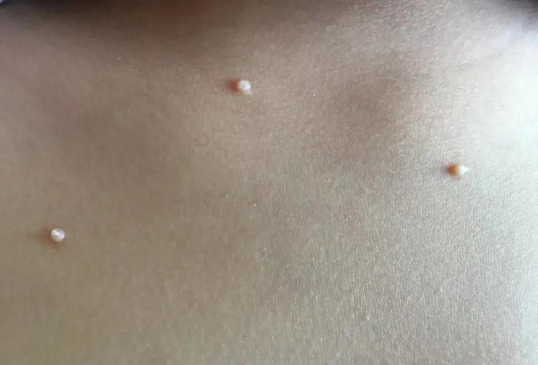 "女友总是偷吃一种药,我一看才知道是治疗传染性软疣的,但是她却跟我