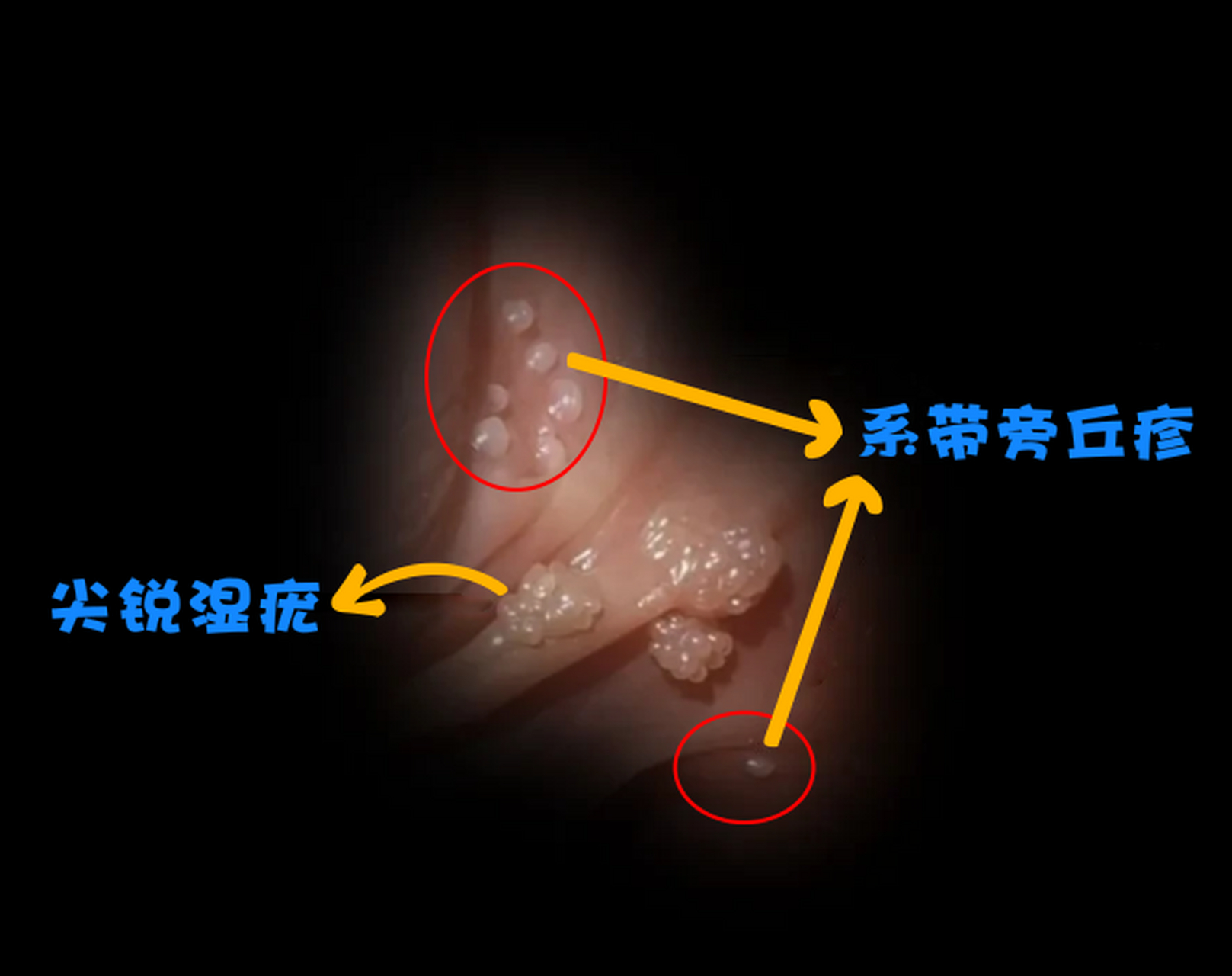 尖锐湿疣和系带旁丘疹都是性病中常见的皮肤问题,但是它们的形态和