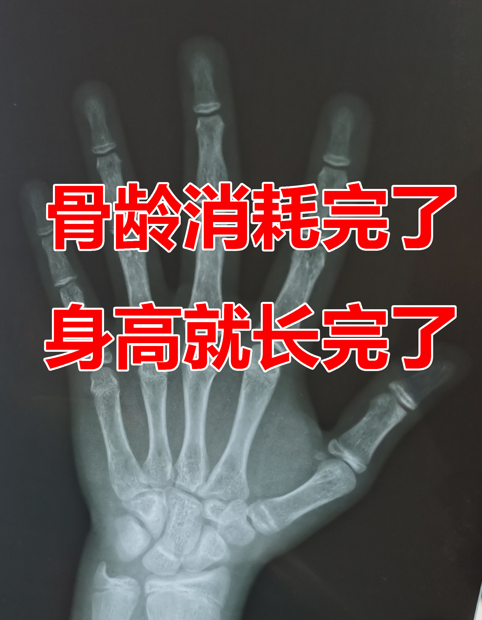 发过来的骨龄片我给评估到165岁生长板已经完全闭合身高已经长完