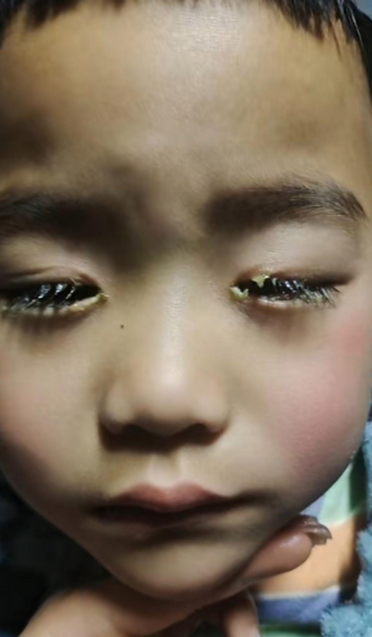 有没有跟我家孩子一样的,早上起来眼睛都睁不开,是怎么回事啊?