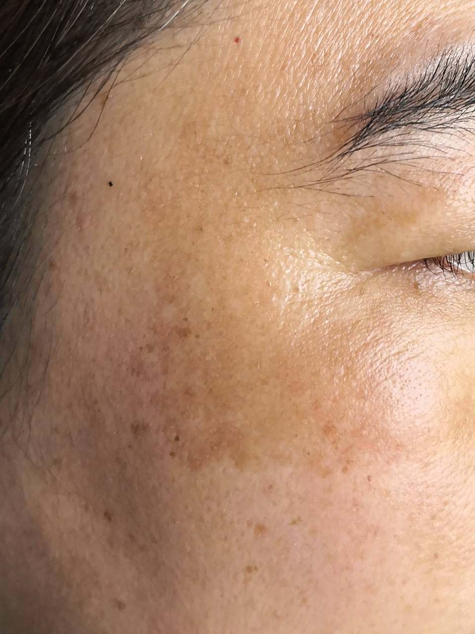 脸上有黄褐斑如何消除?