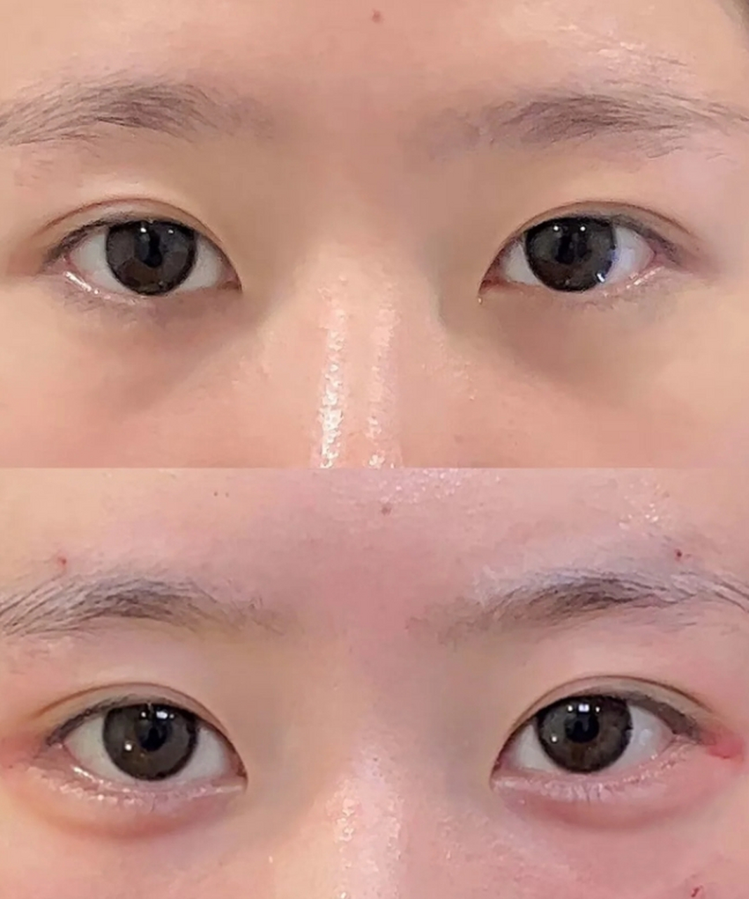 填充卧蚕是一种常见的整容方法,可以使眼部线条更加丰满和年轻.