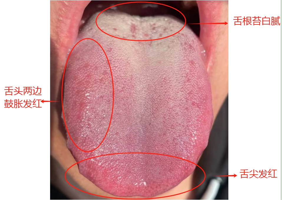 这种舌象最常见