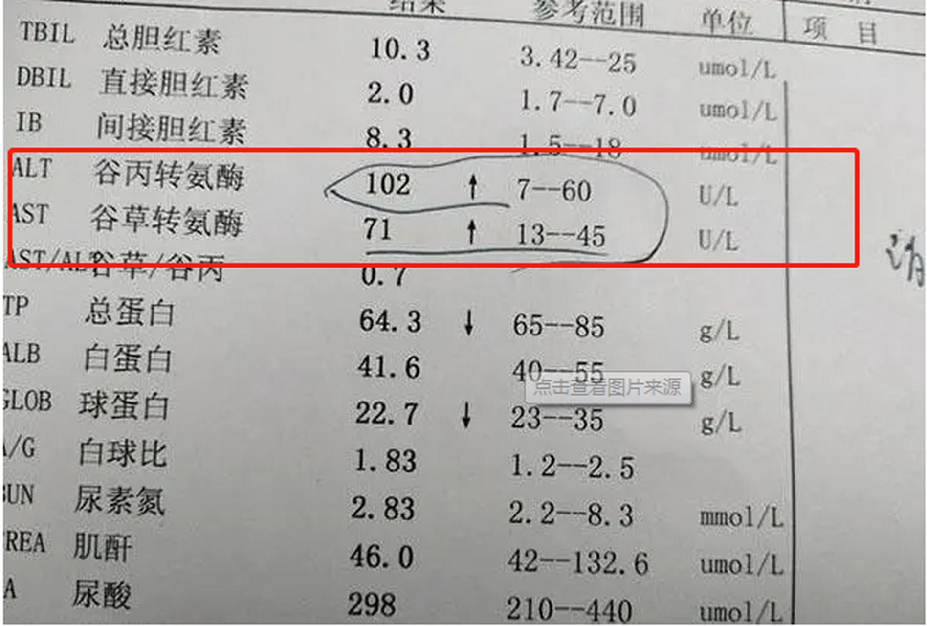 转氨酶高原因图片