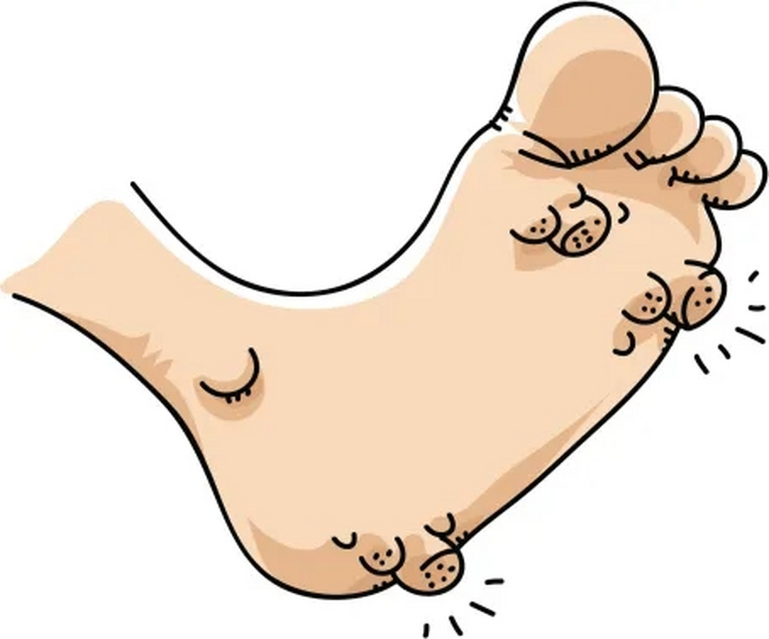 跖疣是由人乳头病毒(hpv)感染引起的一种常见的皮肤