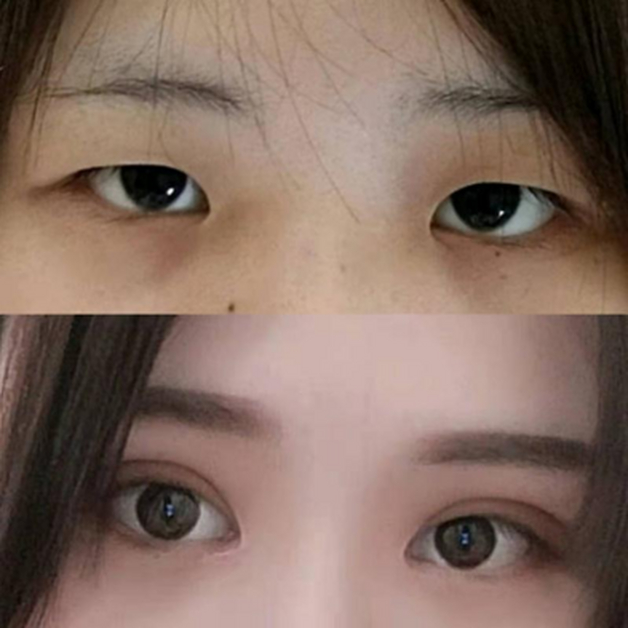 全切双眼皮加去皮去脂,刚做七天期待恢复