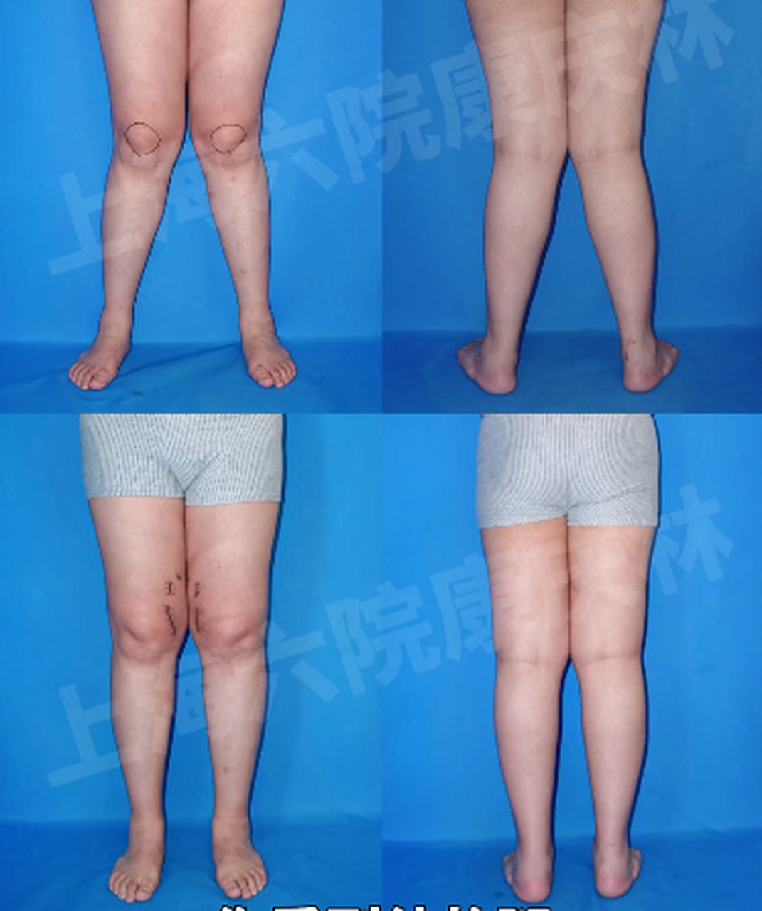 女孩有严重的x型腿,可能诱发骨性关节炎,这是矫正后的效果:  其实x型