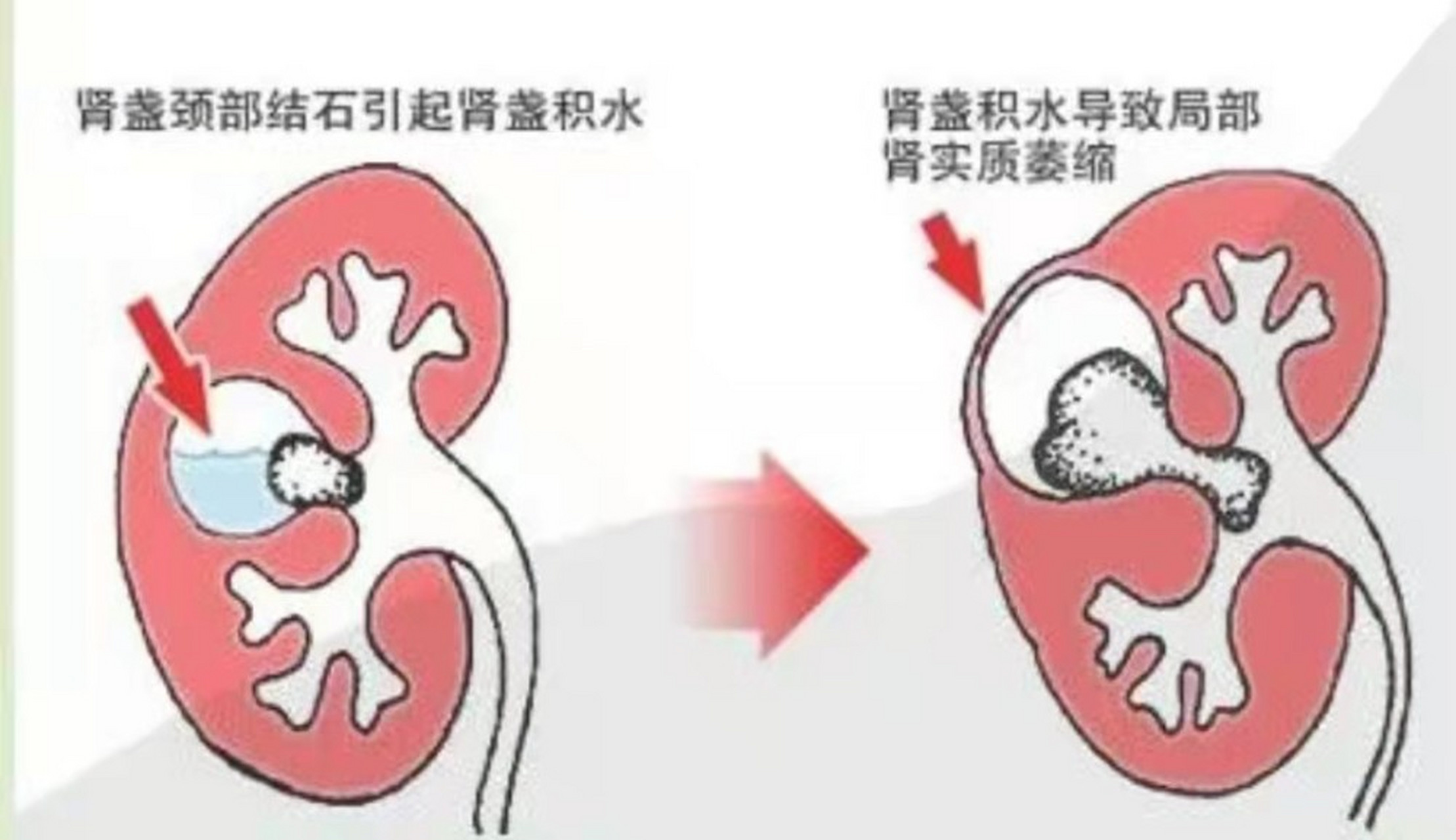 2cm的肾结石并肾积水,如果没有伴随其他不适症状,一般是不严重的.