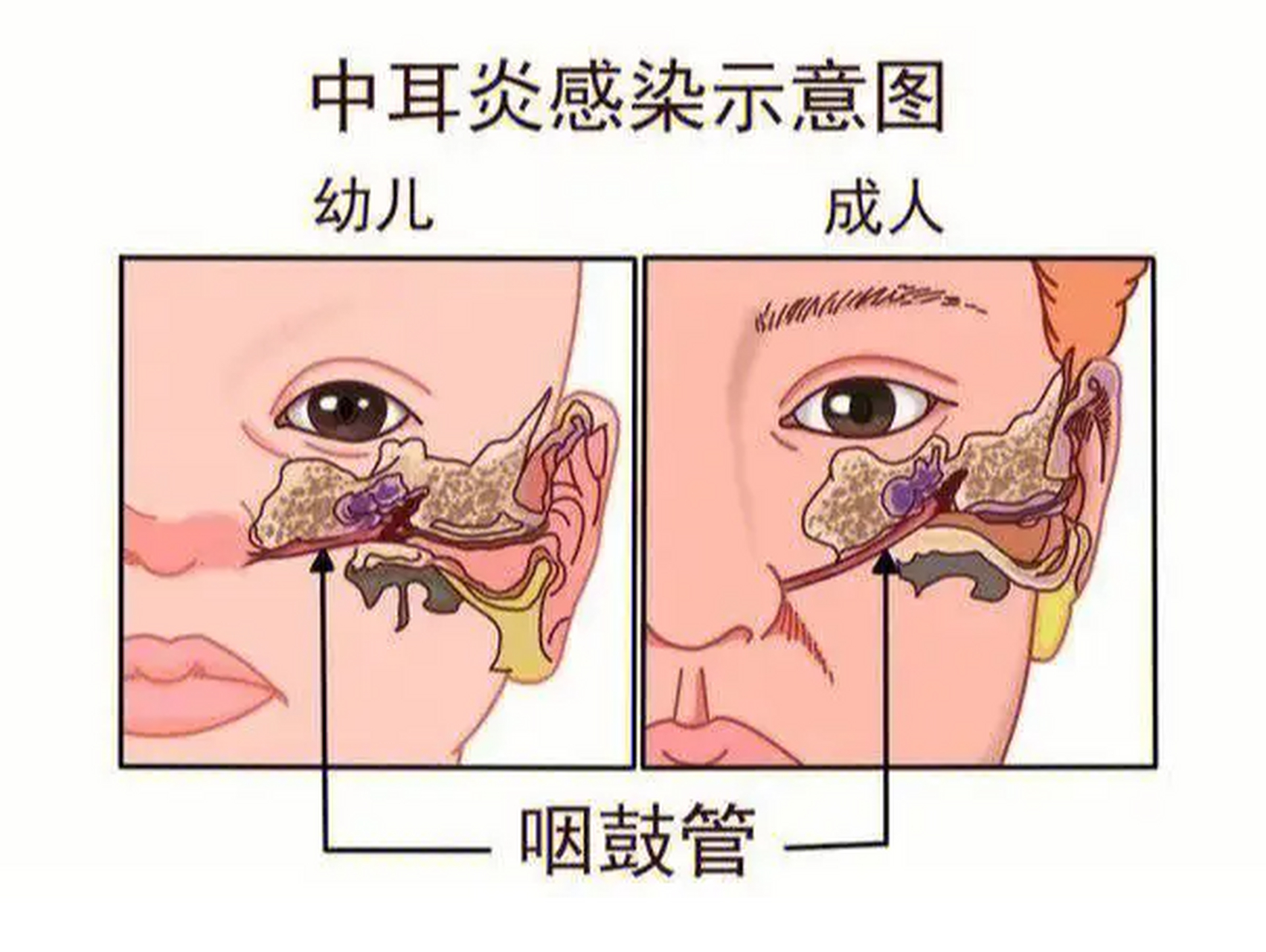 q:中耳炎不能吃什么东西 a:一个慢性炎症感染,需要进行抗炎治疗,感染