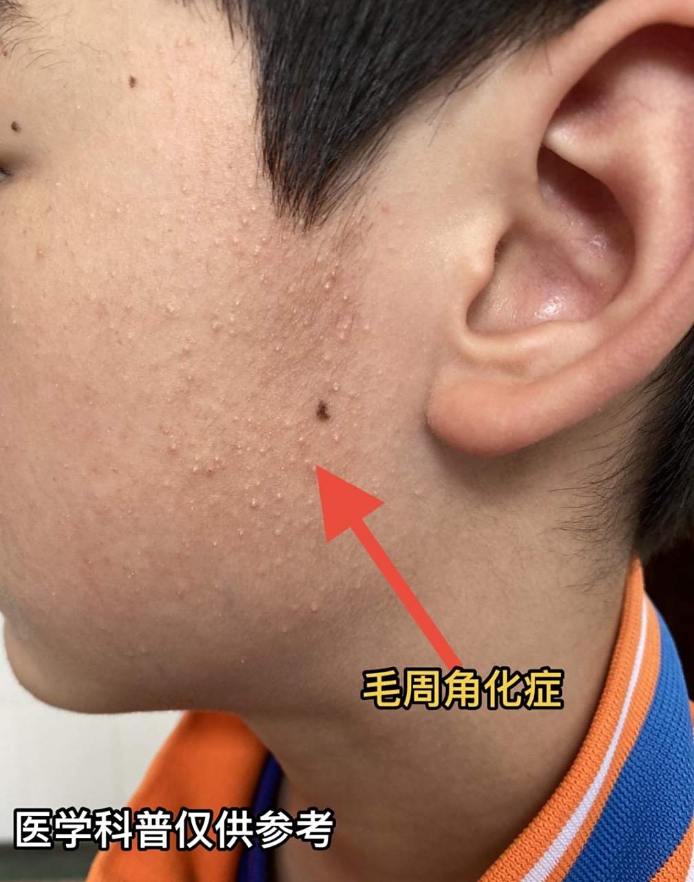 毛周角化症# #鸡皮肤# #皮肤问题# #健康