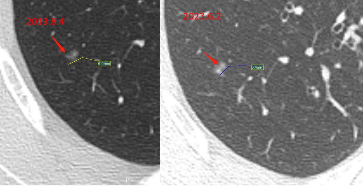 男性,56岁,2013年发现右肺上叶磨玻璃结节,直径约6mm,密度欠均匀.