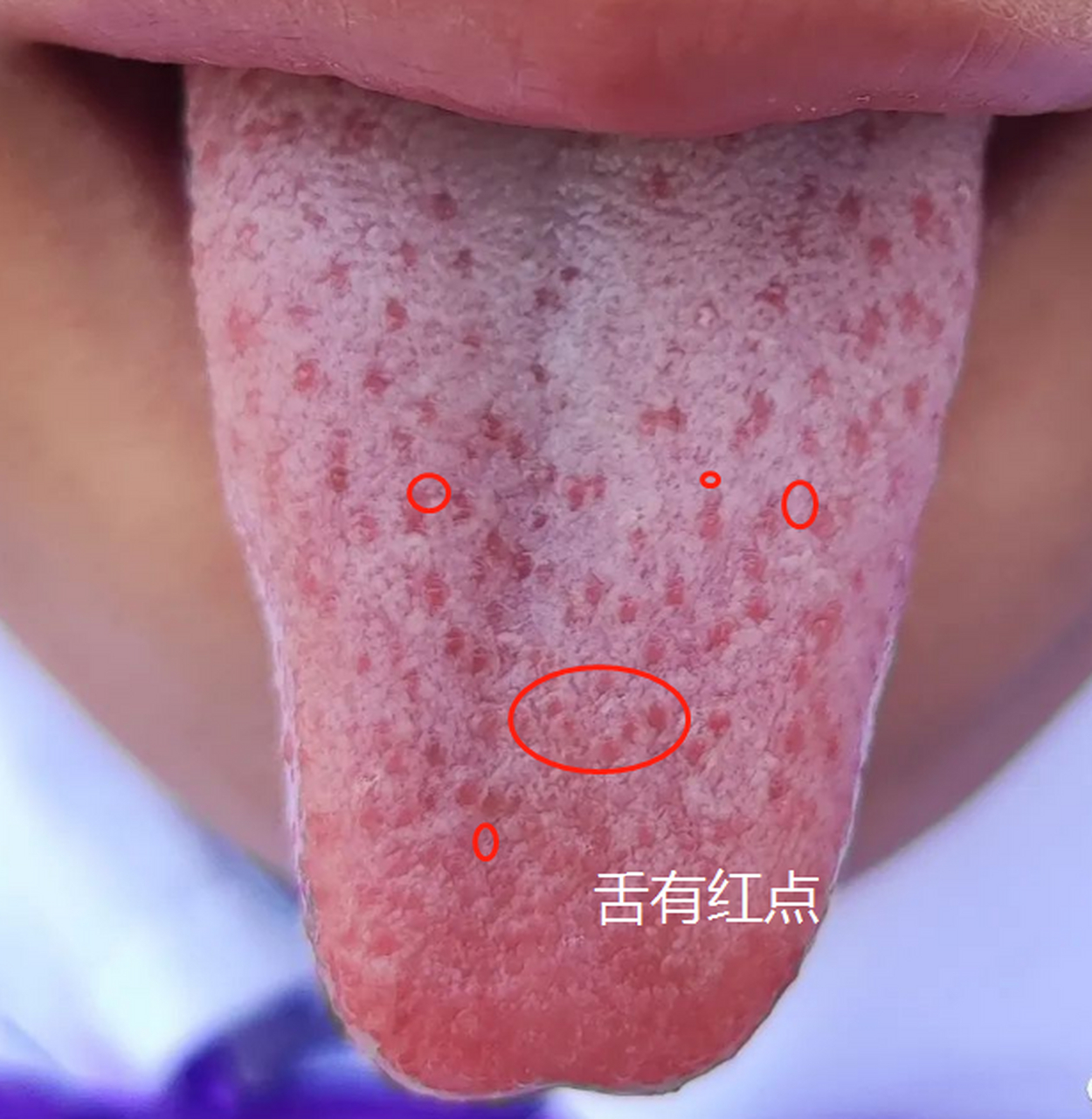 夏天最多这样的舌象,舌苔有明显的红点 这个舌象是明显的"草莓舌"就是