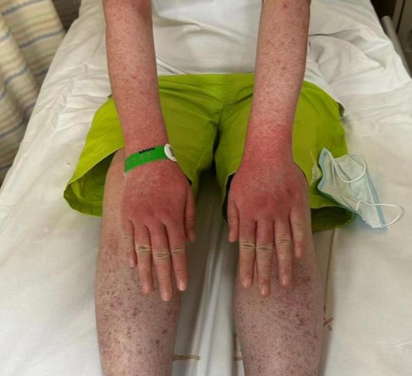 近日,杭州市一名女子的全身被红斑覆盖,脸部甚至变得发紫.