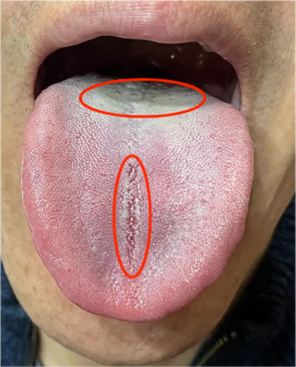 腰膝酸软,那方面能力下降,为什么吃金匮肾气丸没用?看看舌苔就知道!