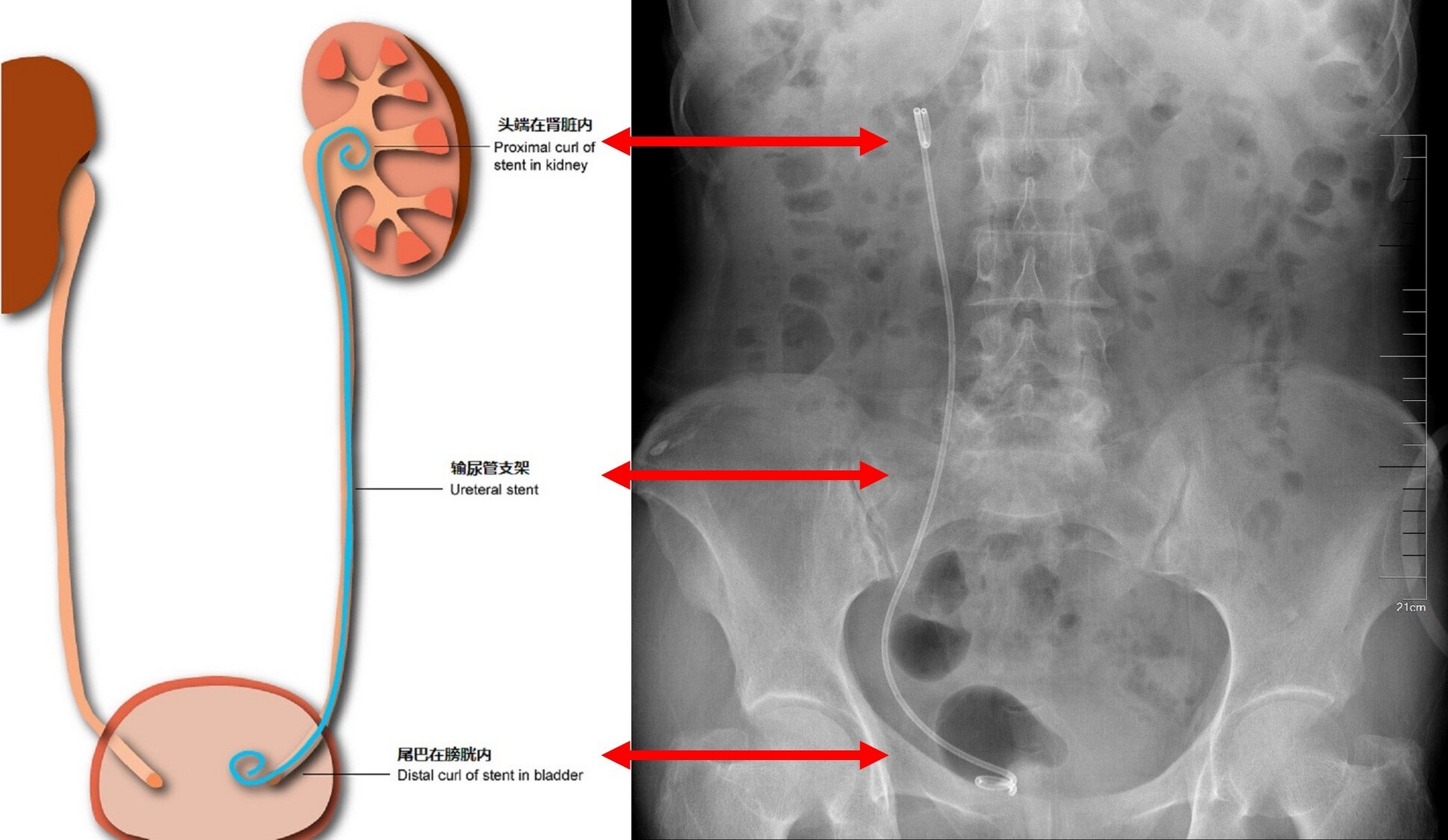 输尿管双j管取出过程图片