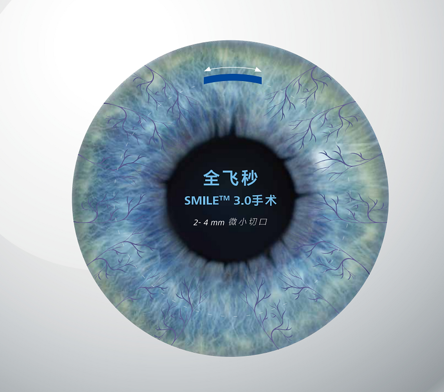原理不同: 全飞秒手术是使用飞秒激光在角膜的基质层制作一个角膜透镜