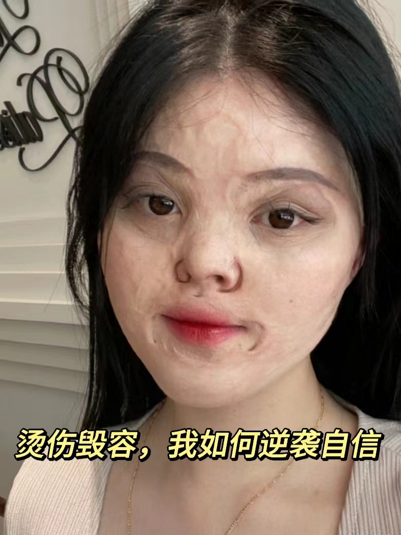 在我小时候,因为一次意外,我被开水烫伤了脸,从此成为了"鬼脸"