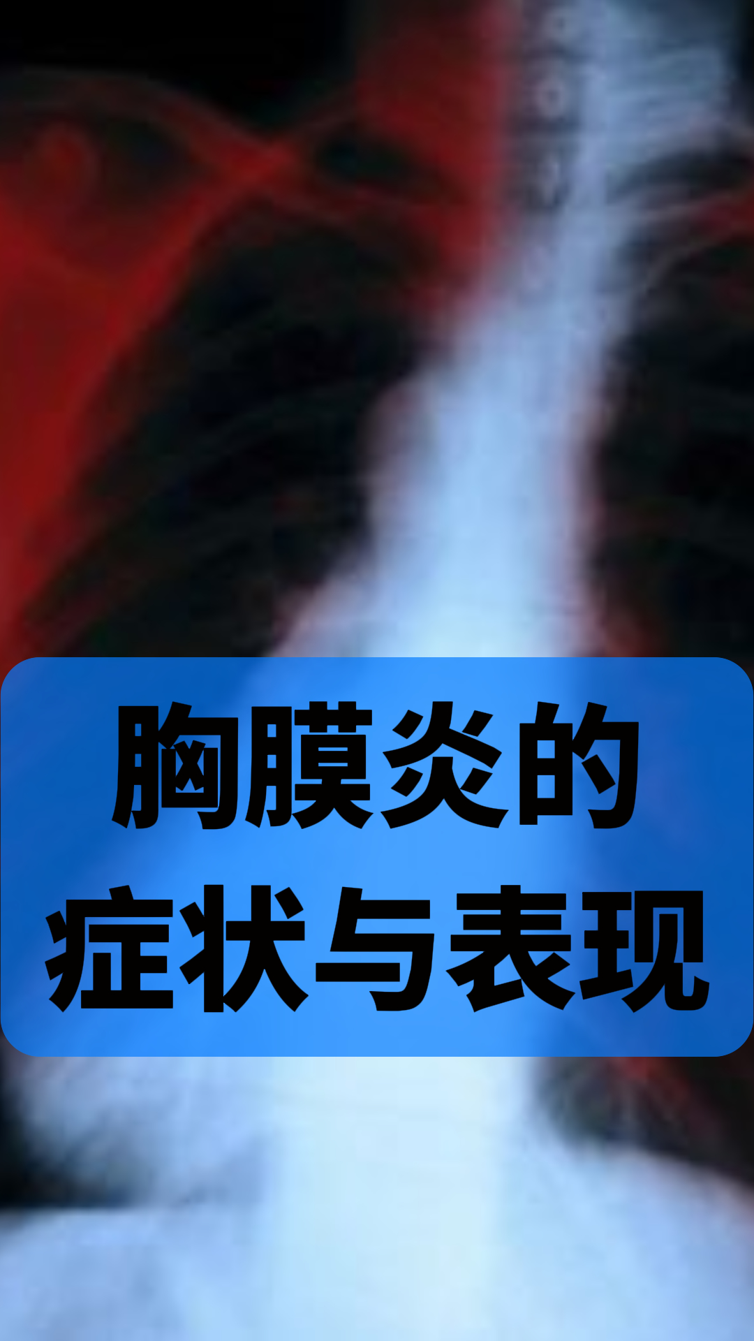 胸痛:胸膜炎最常见的症状是胸痛,疼痛通常位于胸部的一侧或两侧,疼 