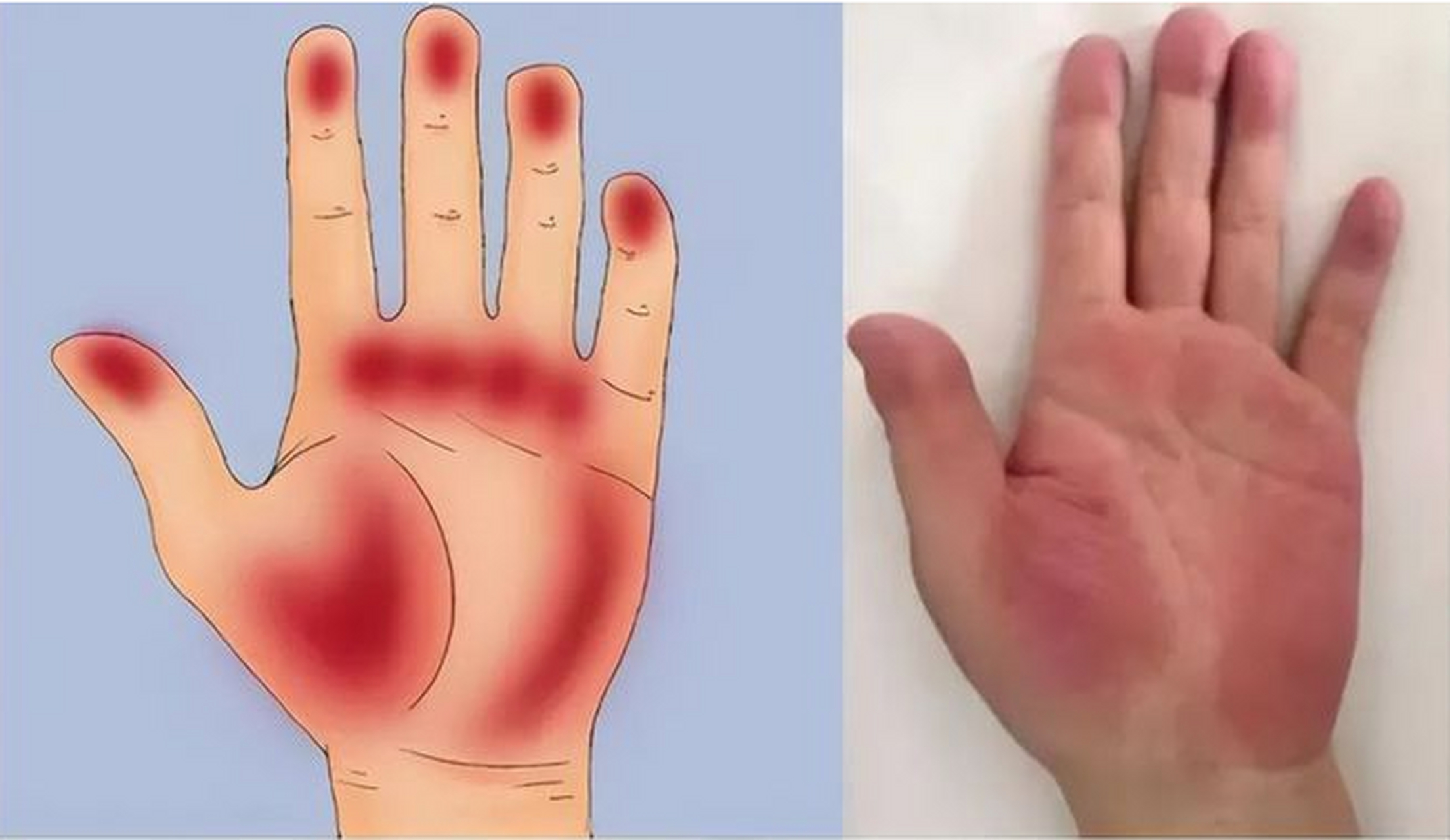 很多人都听说过肝掌,但并不知道具体什么样.