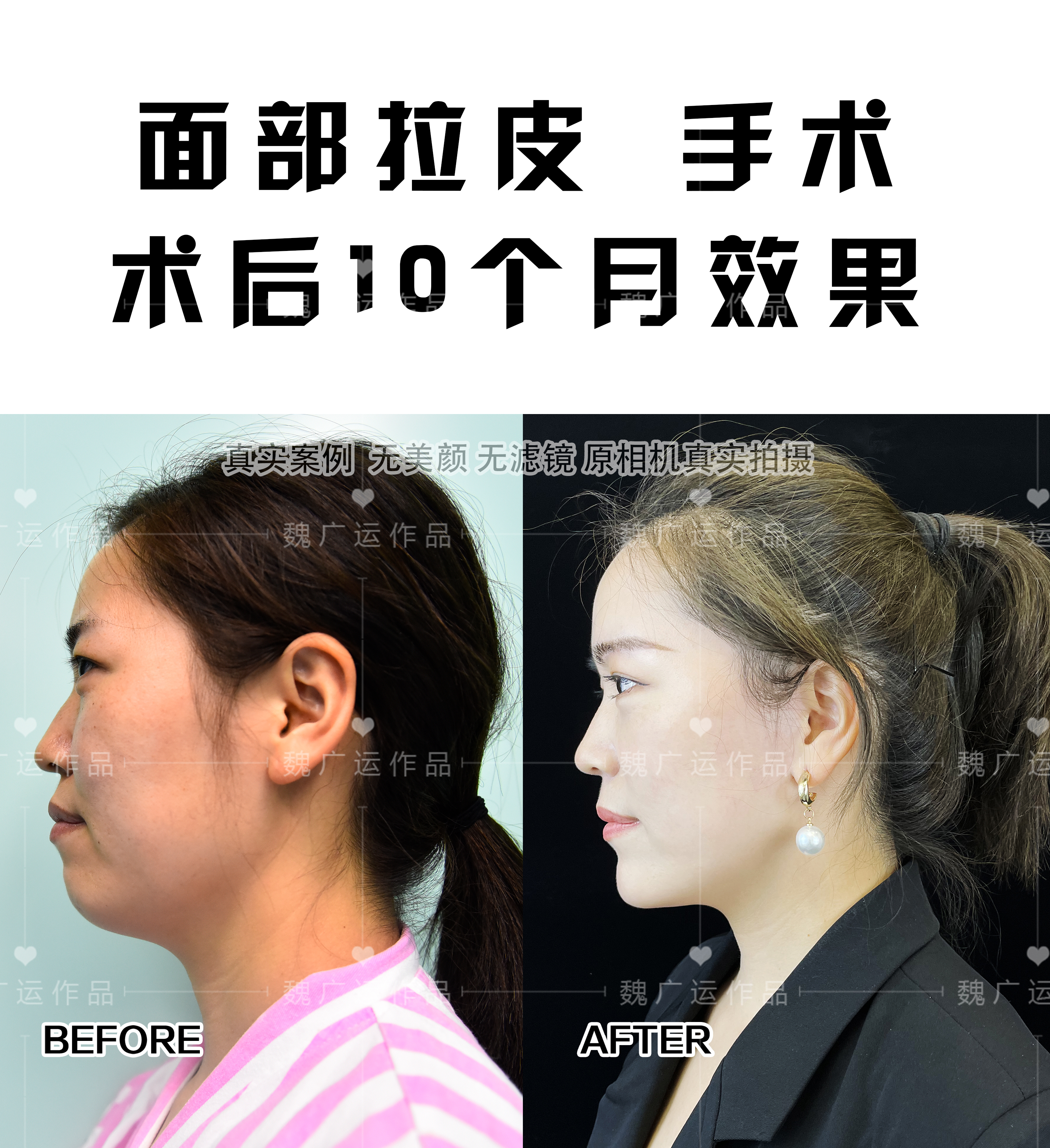 拉皮手术多大年龄做合适?