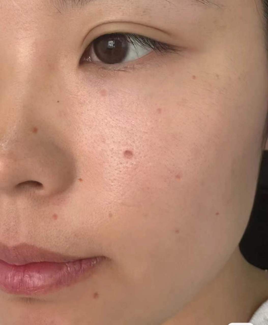 i健康笔记创作赛#  我是脸颊两侧痣比较多,都是色素痣,看图一!