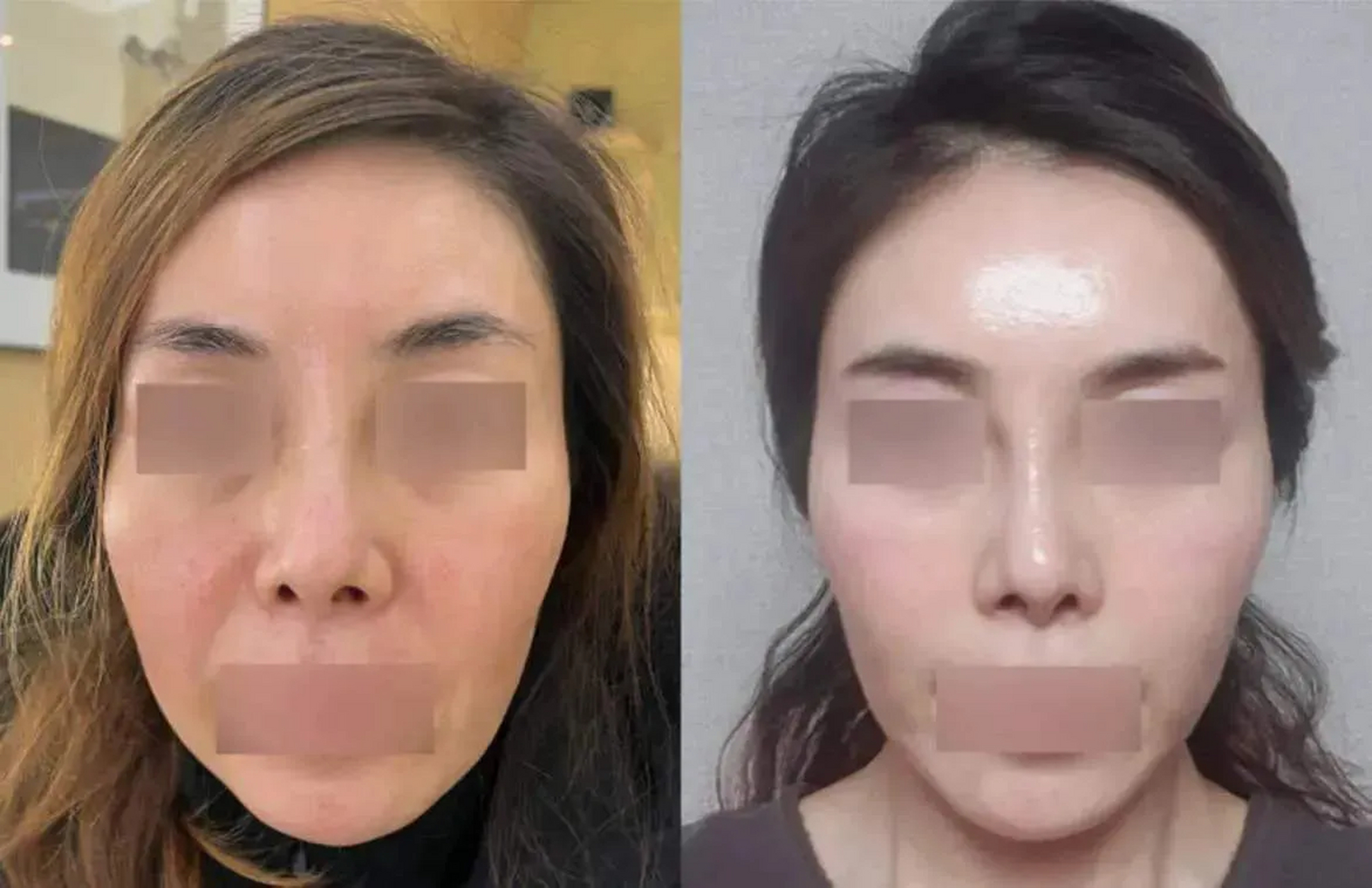 47岁做了苹果肌复位,什么呀,以为多大个手术,其实就是在下眼皮开口,能