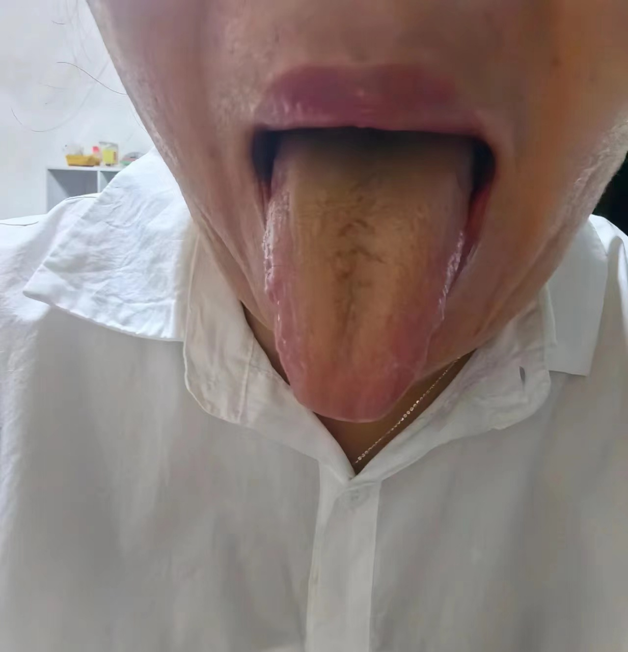 舌中裂纹,脾胃虚弱,消化不良,腹大胀满,胃部不适,大便黏腻不成形,水湿