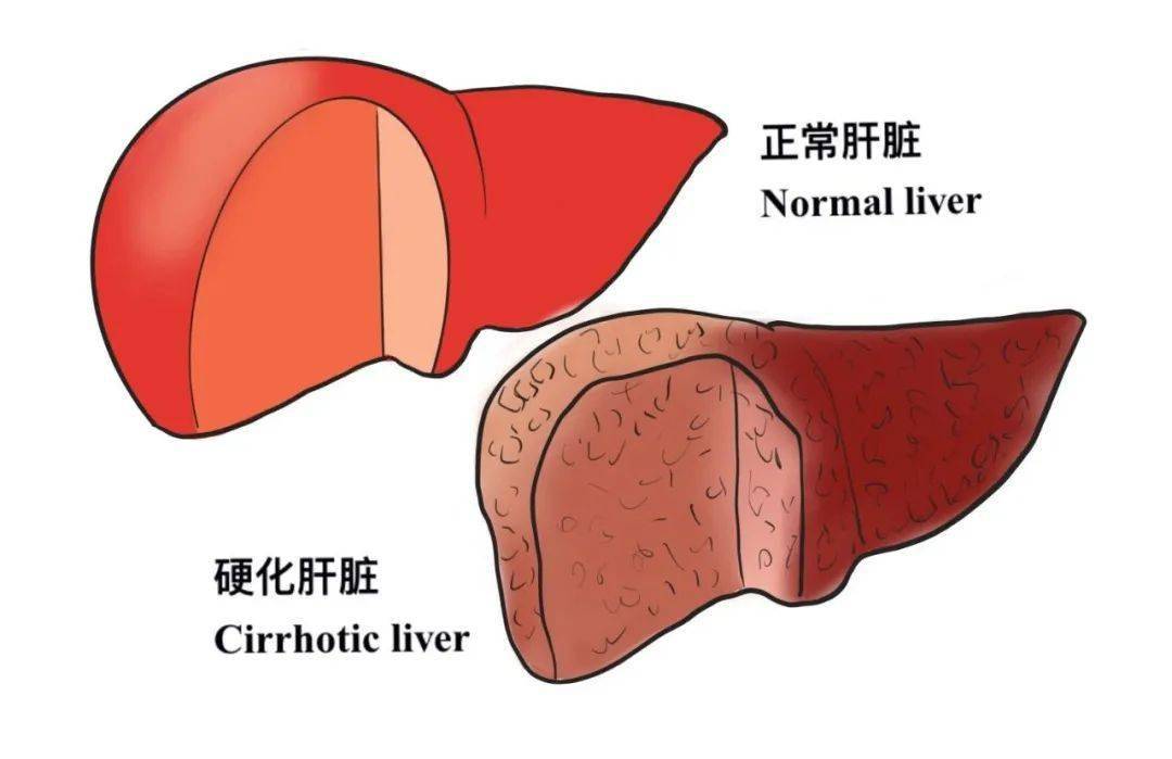 图片肝硬化初期图片肝硬化照片肝硬化早期症状图片肝硬化病人照片大全