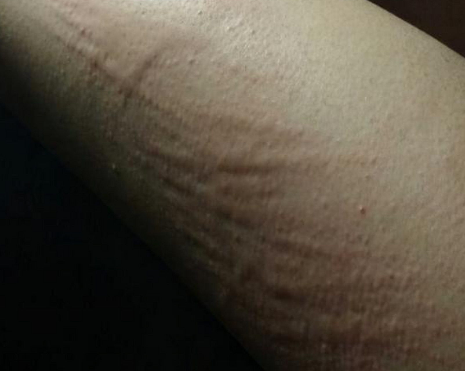 皮肤划痕症也称人工荨麻疹,若症状不明显可不治疗,避免抓挠  皮损划痕