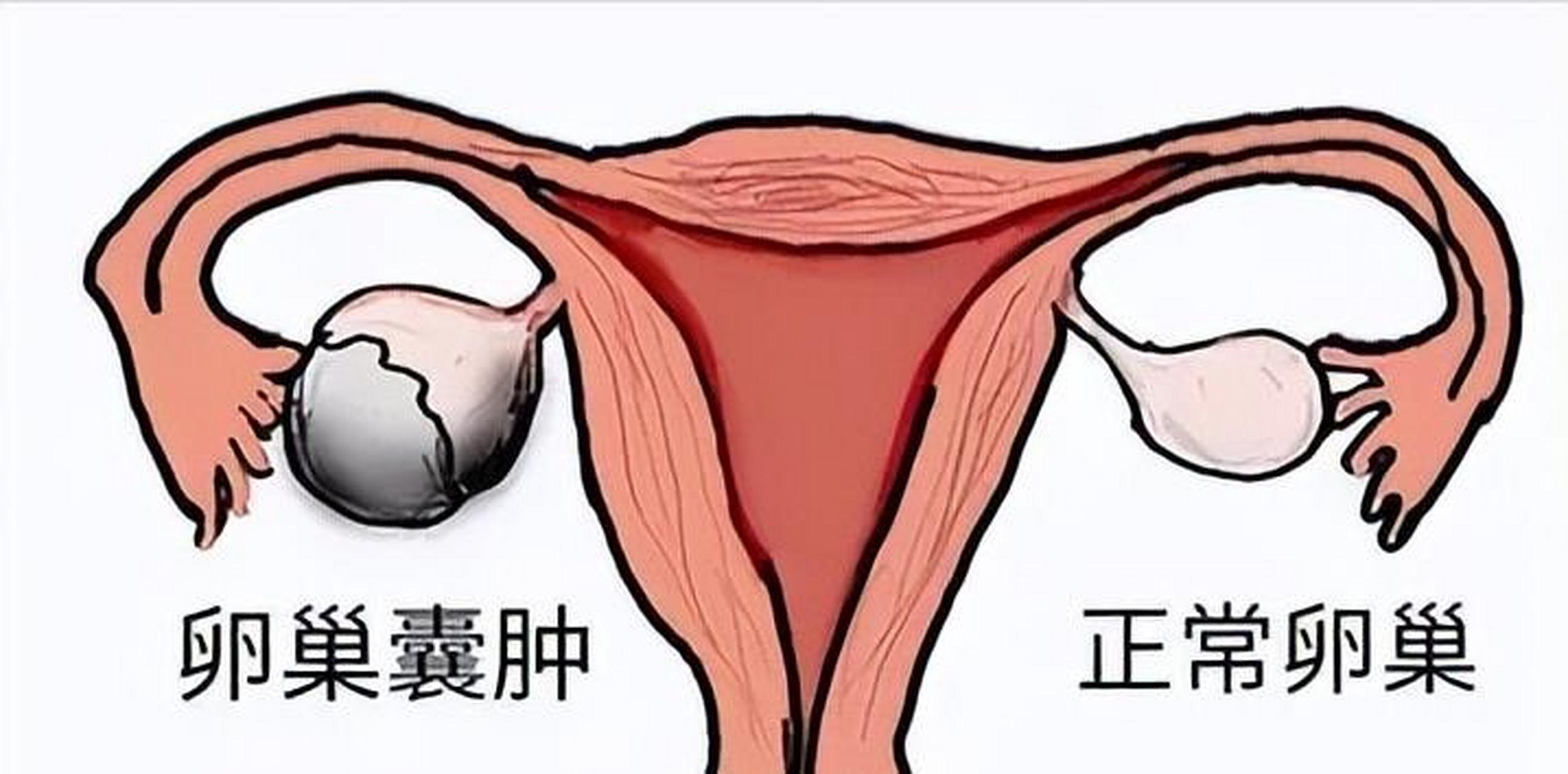 阑尾和右侧卵巢位置图图片