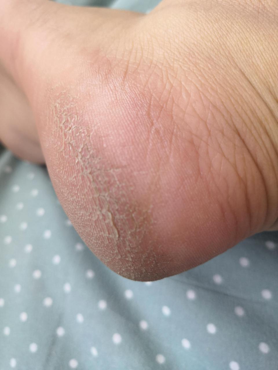 【提问】女,22岁,脚后跟干裂起皮成鱼鳞状,挺长时间了,就顺着皮肤