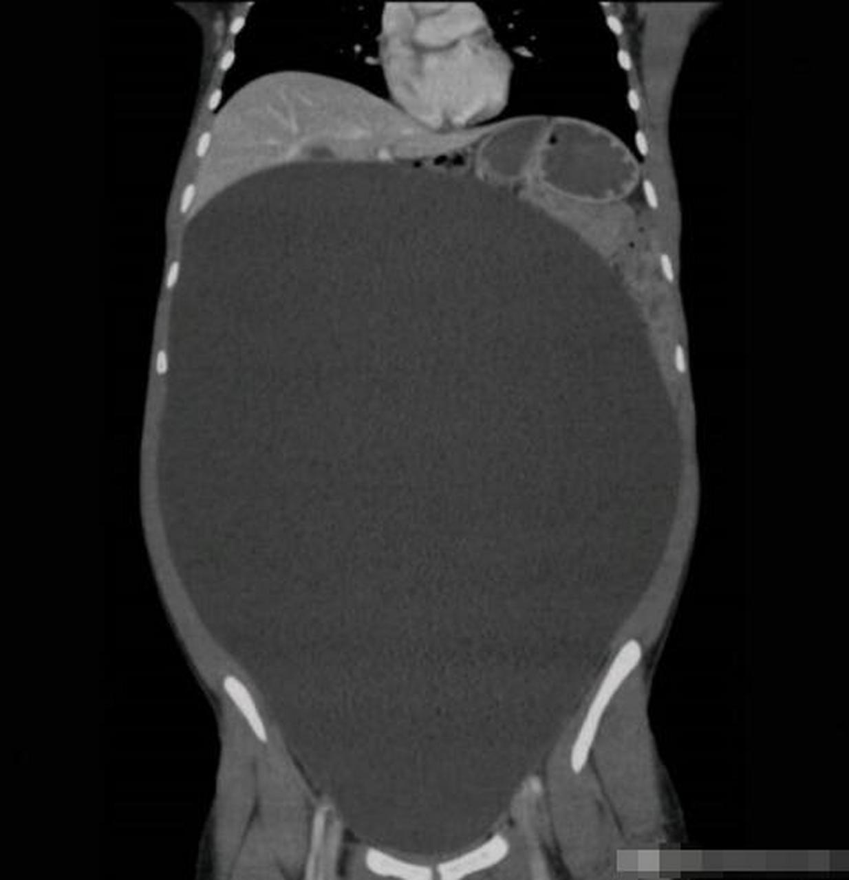卵巢浆液性囊腺瘤是最常见的良性上皮性卵巢肿瘤,多表现为边界清车哪