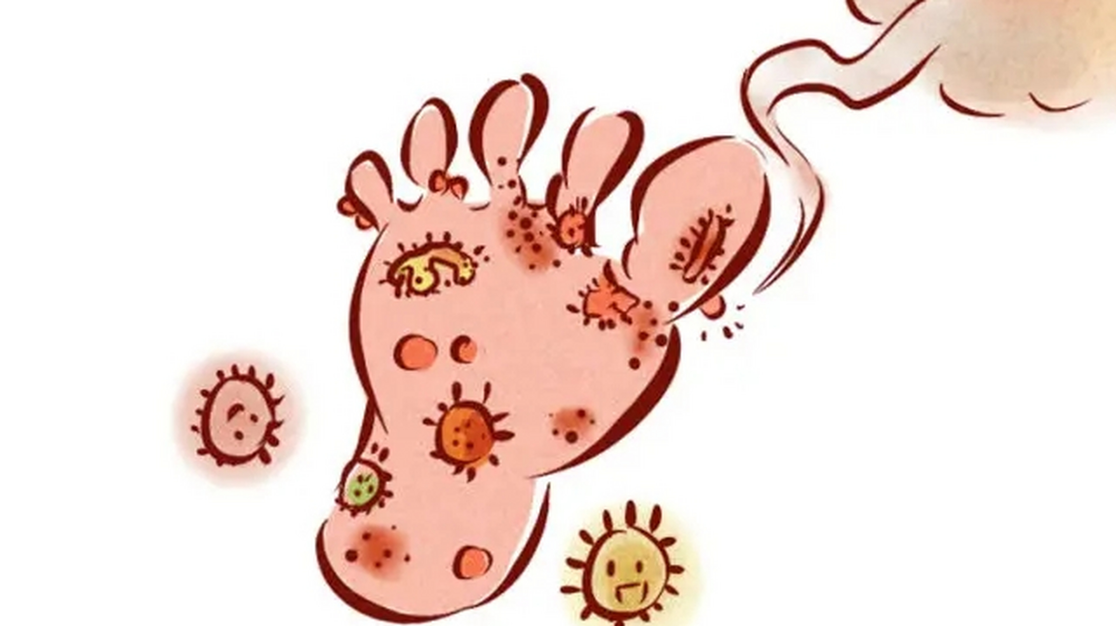 脚臭起水泡,是一种常见的足部皮肤癣病的临床症状,其主要特征是在脚部