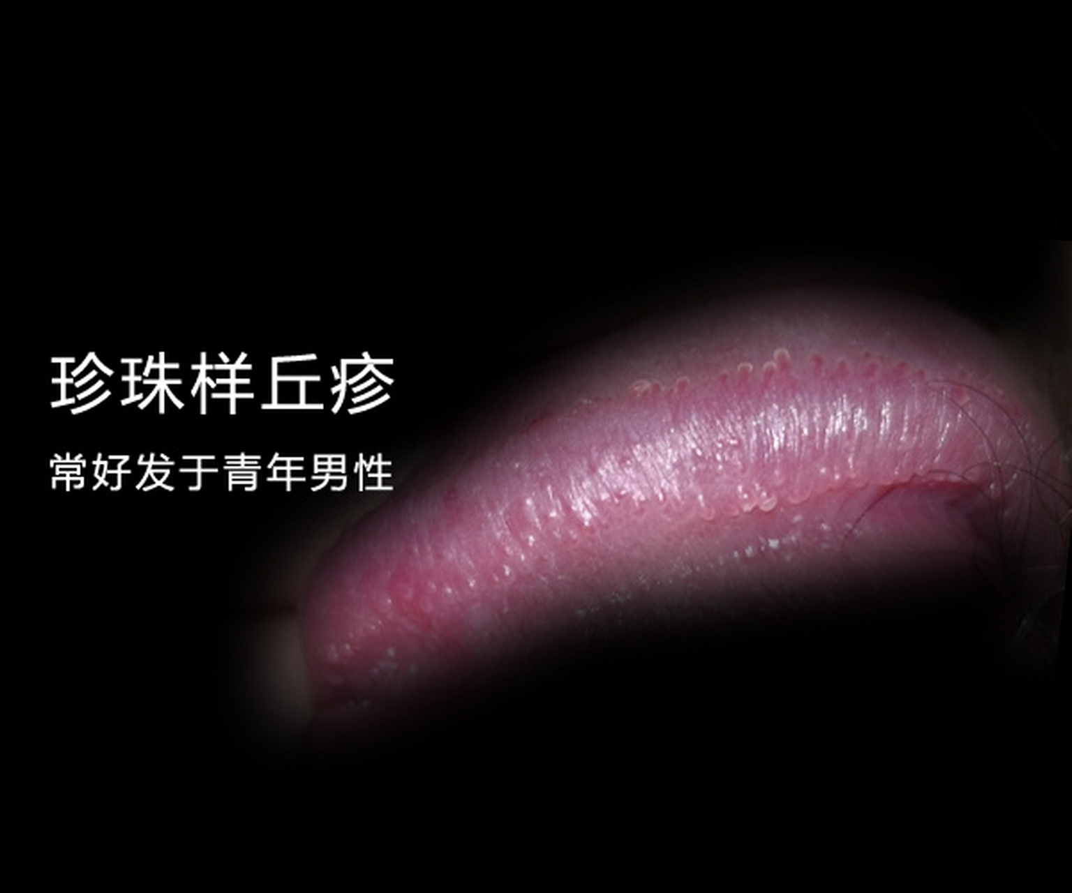 珍珠疹#珍珠疹# 是指珍珠状阴茎丘疹,通常情况下,珍珠状阴茎丘疹不