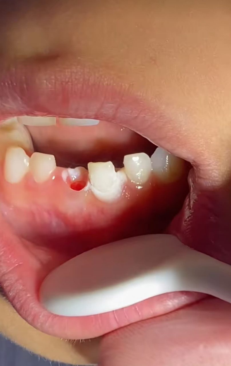 现在的人啊,乳牙会自己掉,你非得人工给拔掉,不知道怎么想的[汗][嘘]