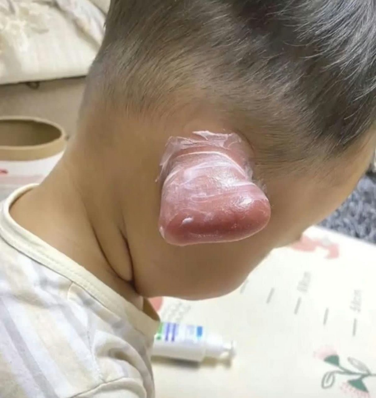 被红蚂蚁咬成这样,真是又心疼又好笑.[二哈]