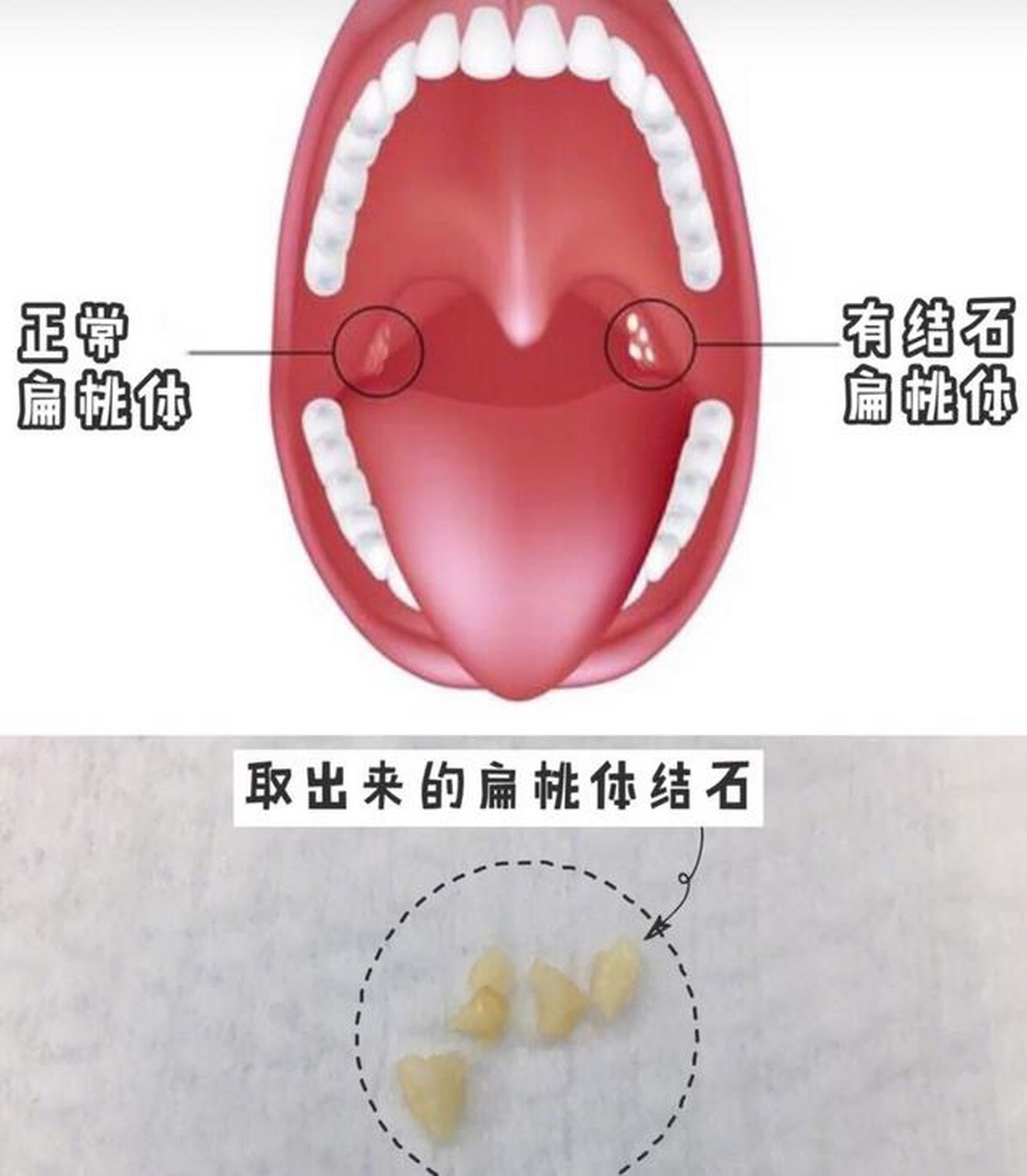 扁桃体结石怎么看图片