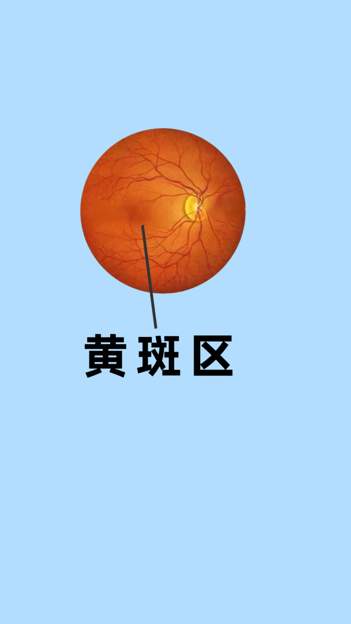 黄斑前膜:黄斑前膜就是在黄斑区以及附近的视网膜表面,产生的一卜非